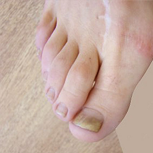 Виды грибковой инфекции ногтей на ногах и ее лечение