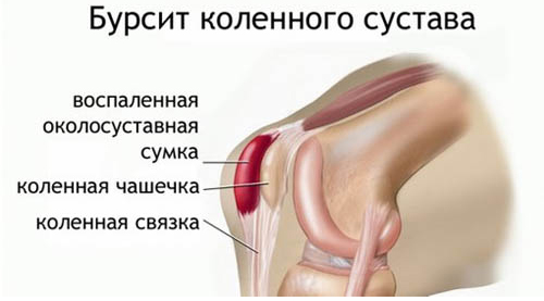 Воспалительный процесс коленного сустава