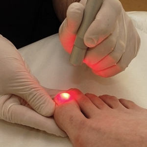 Как вылечить грибковую инфекцию ногтей при помощи лазера