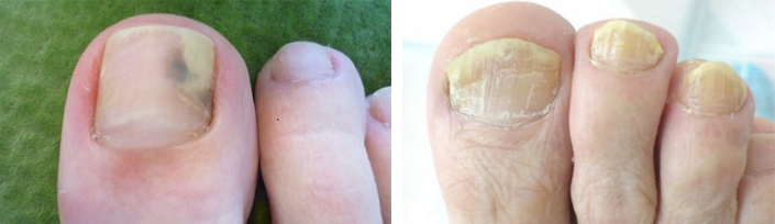 Признаки инфекции на ногтях