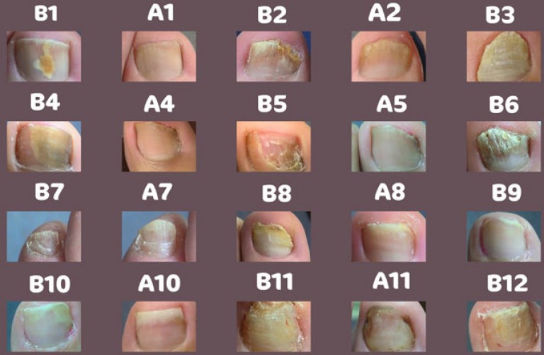 Грибок ногтей симптомы фото