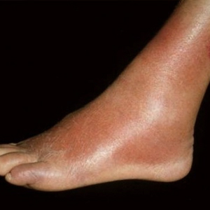 Рожа на ноге - симптомы и особенности терапии