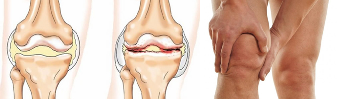 Что делать при повреждении колена
