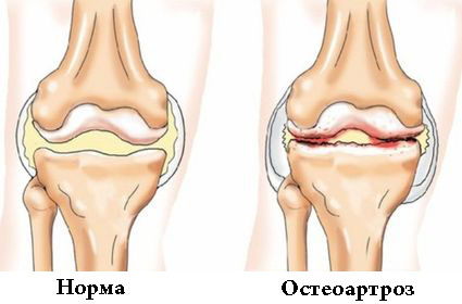 Что такое остеоартроз