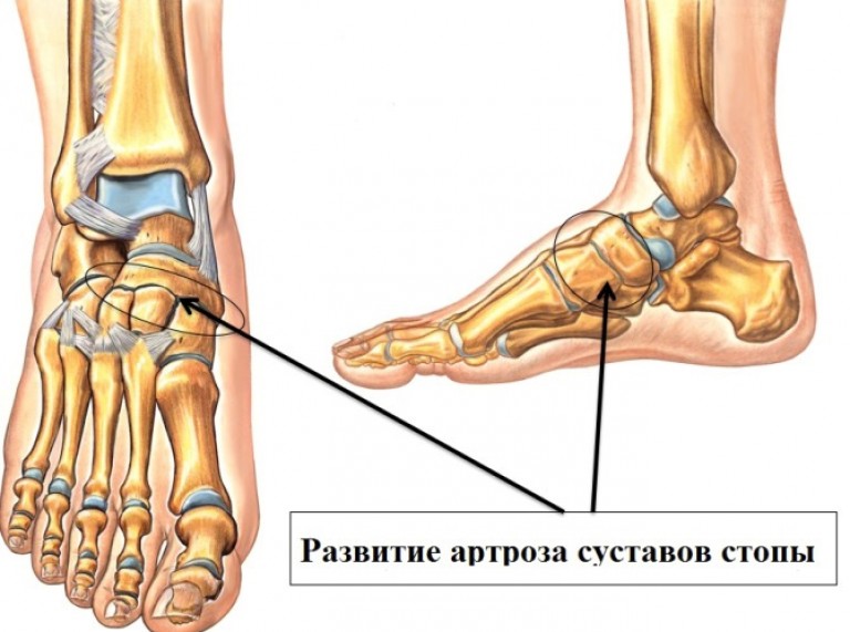 Болезни стопы человека в картинках суставы