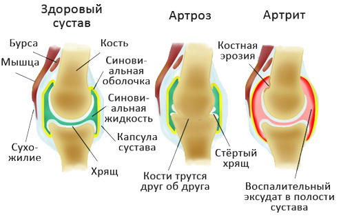 Можно ли вылечить артроз коленного сустава