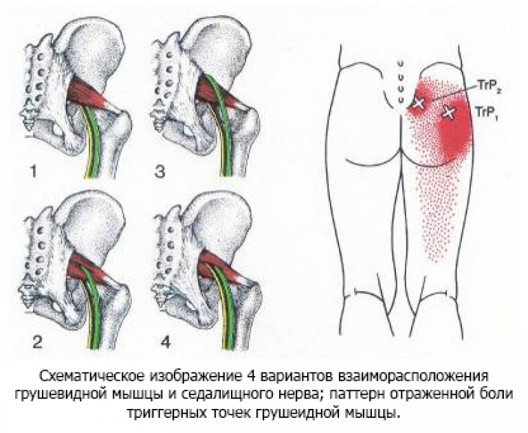 Грушевидная мышца где находится фото. Тазобедренный сустав грушевидная мышца. Грушевидная и седалищный нерв. Синдром грушевидной мышцы боль. Грушевидная (m. Piriformis).