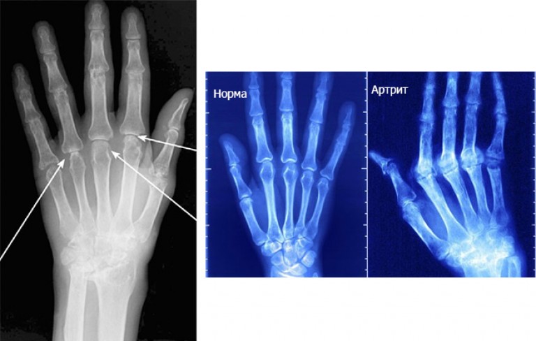 Ревматический полиартрит рентгенологическая картина