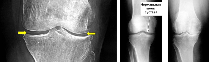 Рентген коленного сустава фото в норме и нет