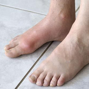 Артроз суставов пальцев ног