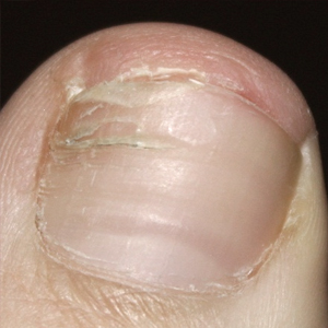 Доктор Мясников о лечении грибковой инфекции ногтей