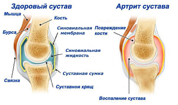 Как проявляется артрит