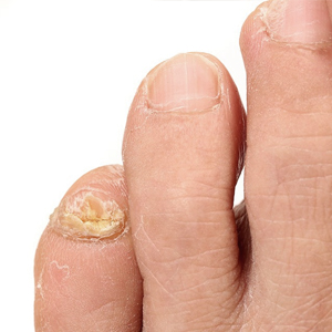 Как проявляется грибковая инфекция на ногтях ног