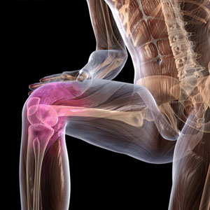 Лечение второй степени деформирующего артроза колена