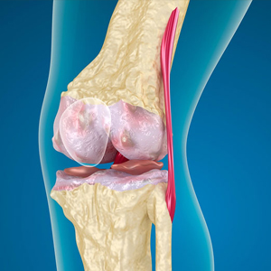 Особенности лечения артроза колена на 3 стадии