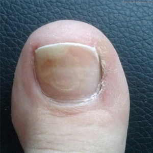 Спреи от грибковой инфекции ногтей на ногах