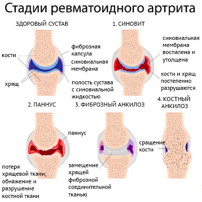 Стадии ревматоидного артрита