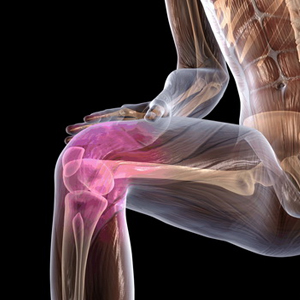 Что такое деформирующий артроз сустава колена
