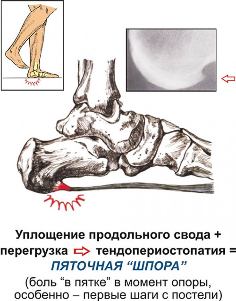 Фото пяточной шпоры на ноге