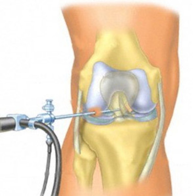 Удалить мениск колена. Артроскопия мениска коленного сустава. Операция артроскопия коленного сустава. Артроскопическая резекция мениска. Артроскопия ПКС коленного сустава.