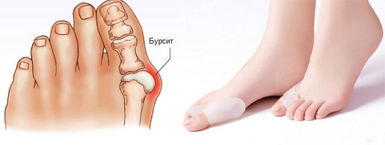 Лечить сустав большого пальца ноги. Бурсит плюснефалангового сустава 1 пальца. Бурсит 1 плюснефалангового сустава. Бурсит большого пальца стопы стопы.