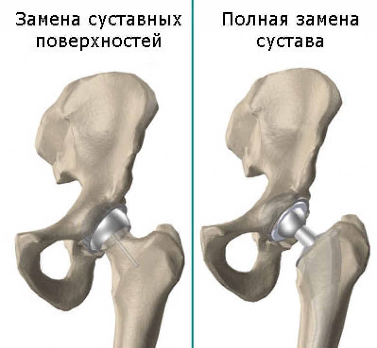 Операция замена сустава бедра. Асептический некроз головки бедренной кости. Эндопротез головки тазобедренного сустава. Асептический некроз головки тазобедренного сустава. Асептический некроз головки бедренной кости протезирование.