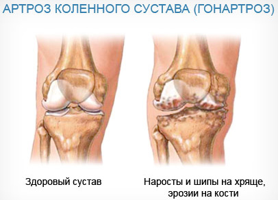 Можно ли вылечить артроз коленного сустава