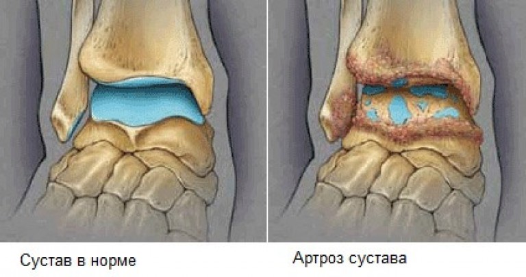 Артроз стопы лечение фото Как лечится посттравматический артроз голеностопа? - Здоровые и красивые ноги