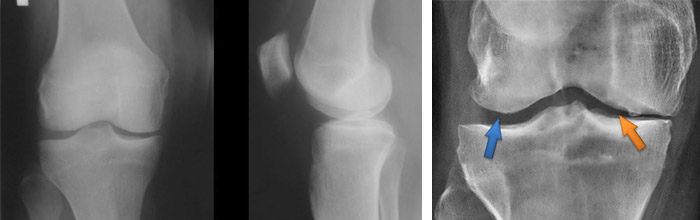 пателлофеморальный сустав рентген. хондромаляция пателлофеморального сустава. пателлофеморальный сочленение артроз. пателлофеморальный сочленение артроз. пателлофеморальный артроз 1 степени.