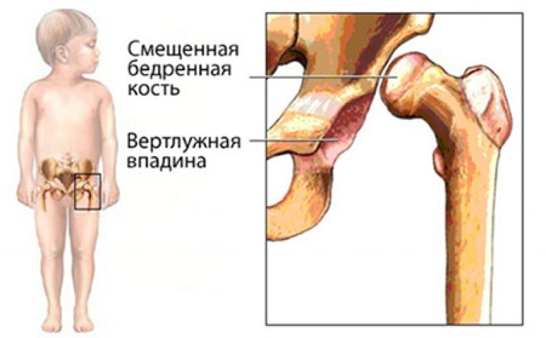 Вывих тазобедренного сустава у взрослых симптомы. Врождённый вывих бедра дисплазия. Дисплазия подвывих тазобедренного сустава.