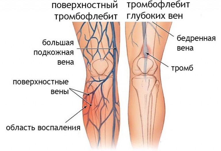 Тромбофлебит верхних конечностей лечение препараты схема