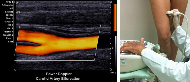 Дуплексное сканирование артерий нижних конечностей