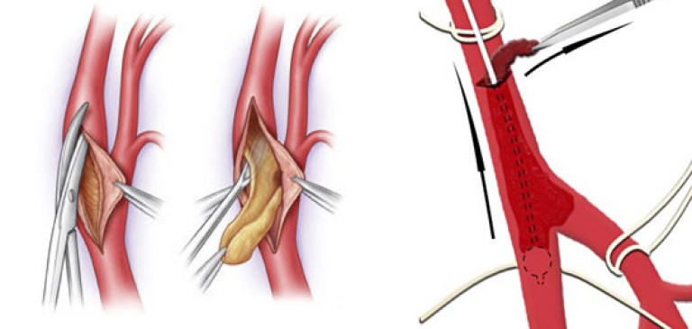 Тромб артерия операция
