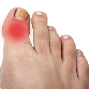 Артроз суставов на больших пальцах ног