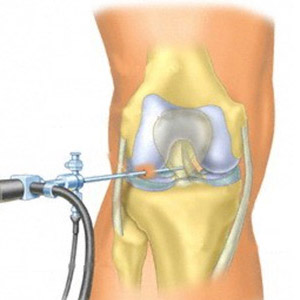 Артроскопия сустава колена - что это такое