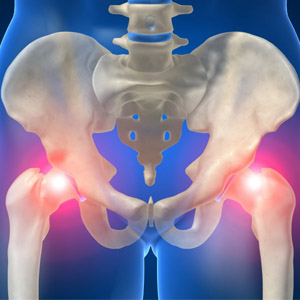 Деформирующий остеоартроз в области тазобедренного сустава