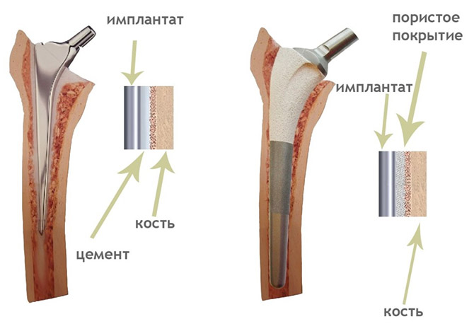 Как делаются протезы