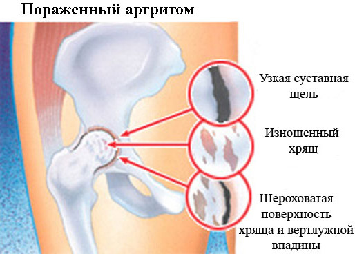 Особенности артрита