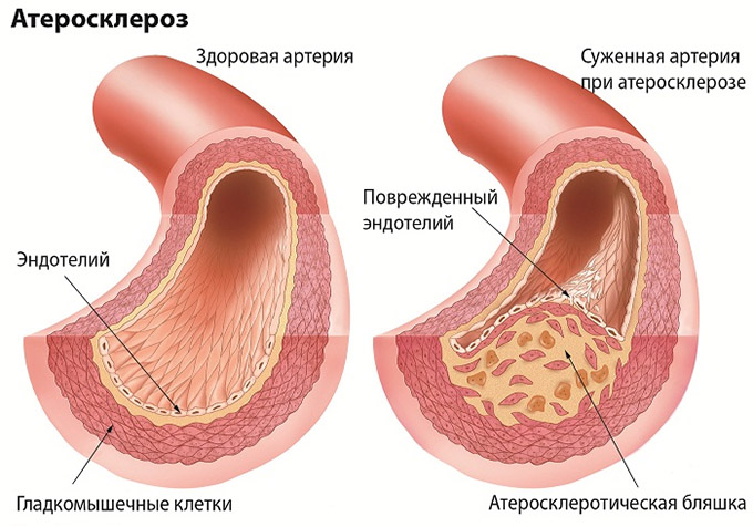 Патология артерий