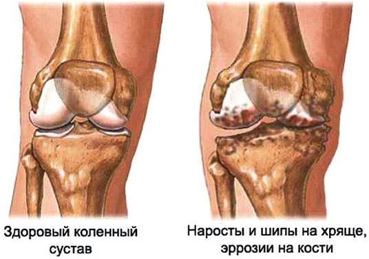 Повреждения колена