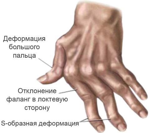 Признаки ревматоидного артрита