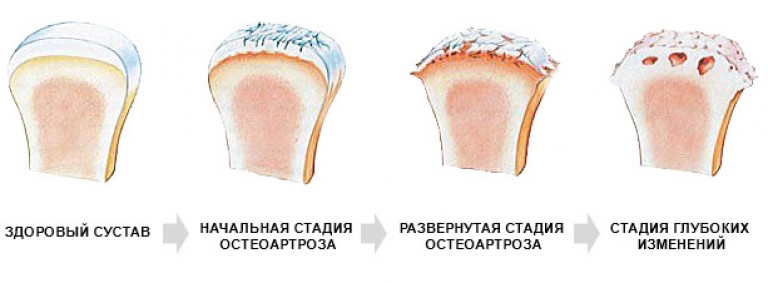 Гонартроз 2 степени фото