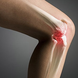 Терапия при деформирующем артрозе коленного сустава второй степени