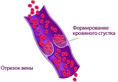 Формирование сгустка крови