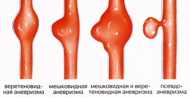 Шишка под коленом сзади фото