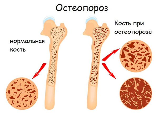 Что такое остеопороз