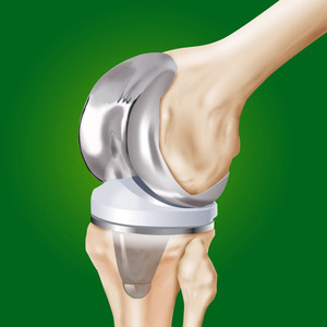 Что такое эндопротезирование сустава колена