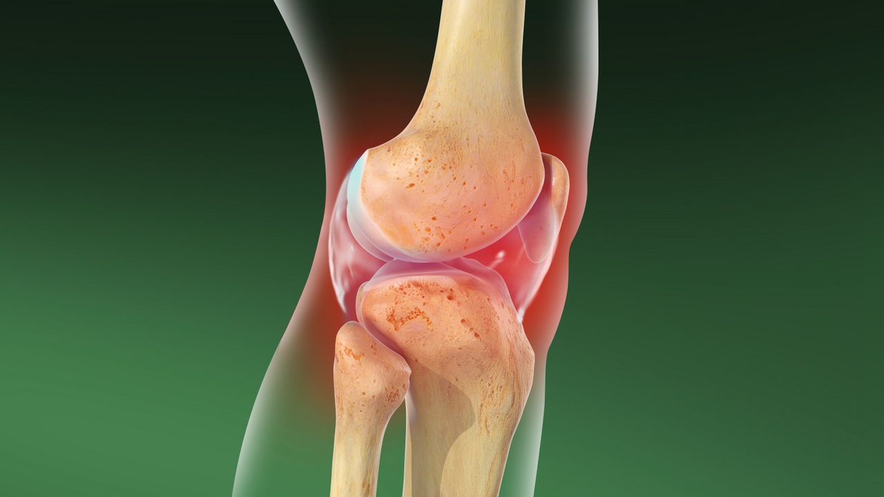 Протез коленного сустава – когда оперировать