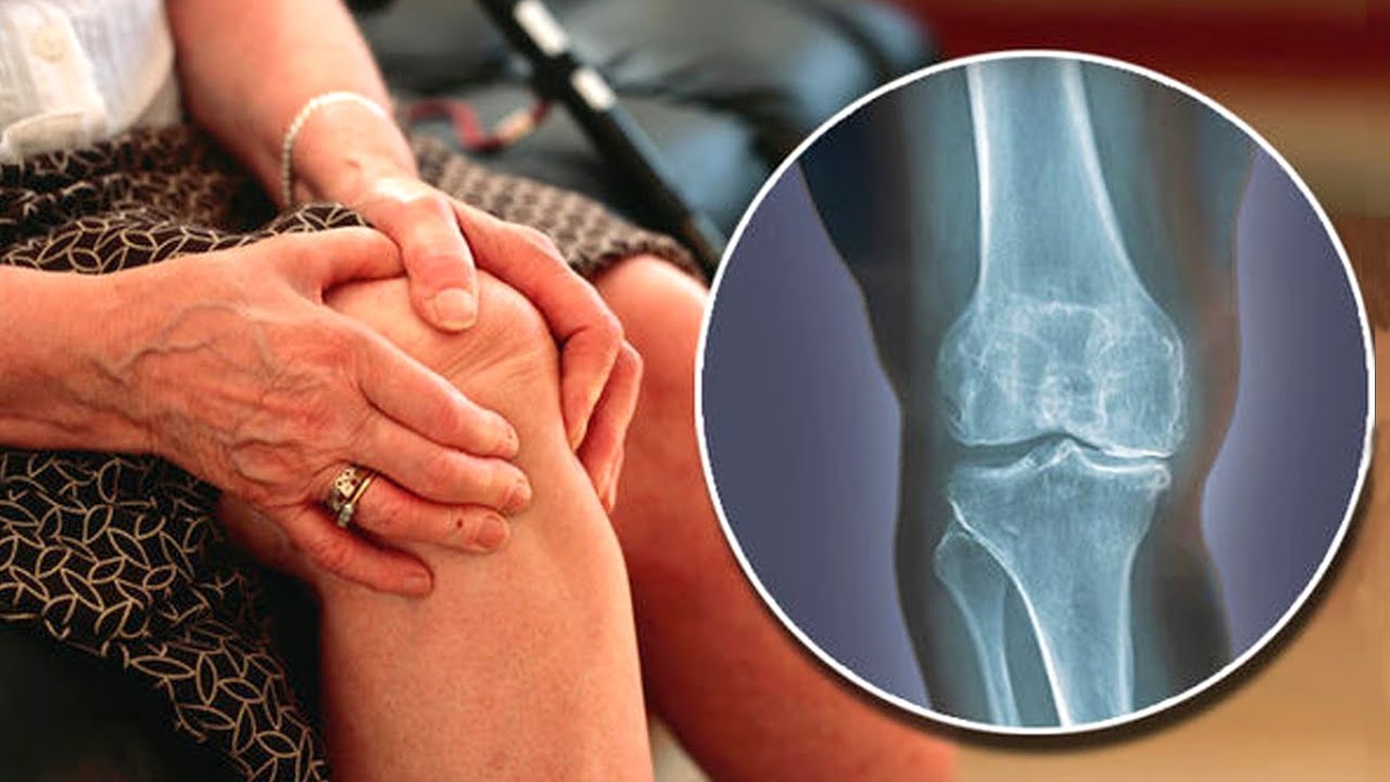 Протез коленного сустава – когда оперировать